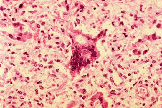 Unvaccinated Austin Infant Sparks Travis County's Second Measles Case of 2026