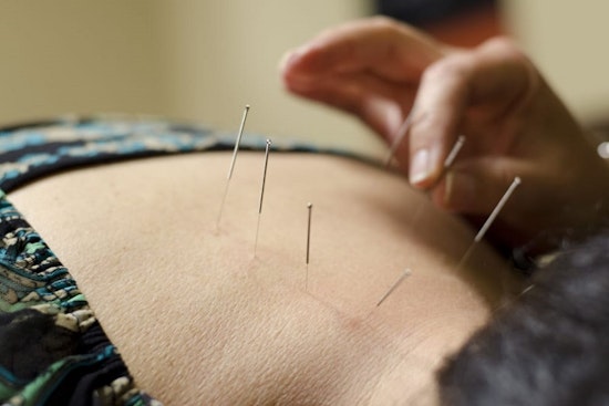 Here are Mesa's top 5 acupuncture spots