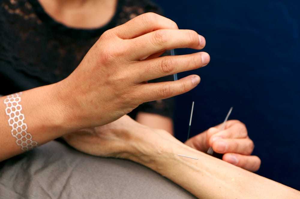 The 4 best acupuncture spots in Berkeley