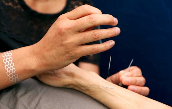 The 4 best acupuncture spots in Berkeley