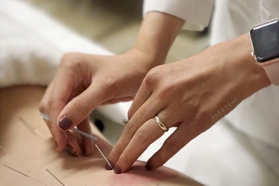 The 5 best acupuncture spots in Anaheim