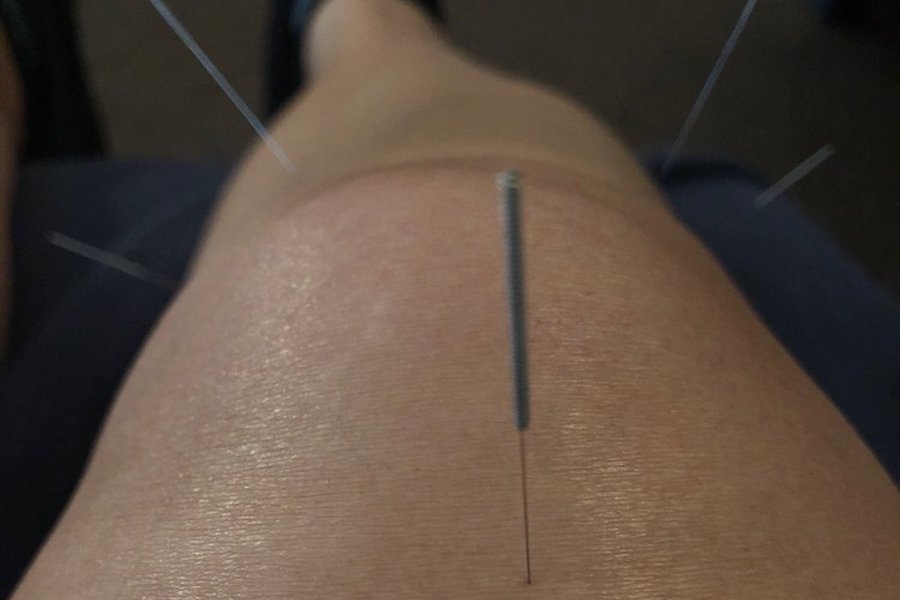 The 5 best acupuncture spots in St. Louis